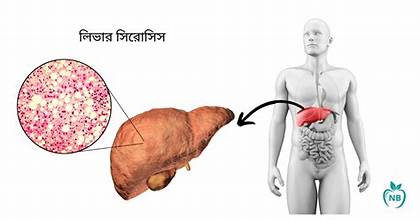 অ্যালকোহলসেবন ও লিভার সিরোসিস অ্যালকোহলসেবন ও লিভার সিরোসিস: একটি প্রাণঘাতী সম্পর্ক
